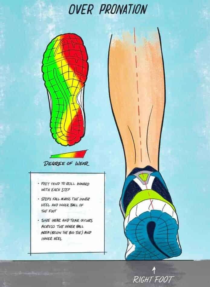 over pronation